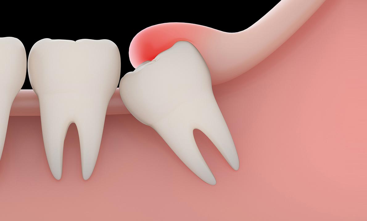 emergency wisdom tooth extraction